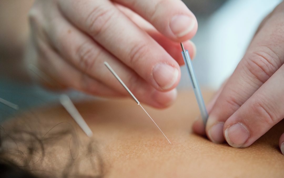 L’acupuncture aiderait-elle la FIV ?